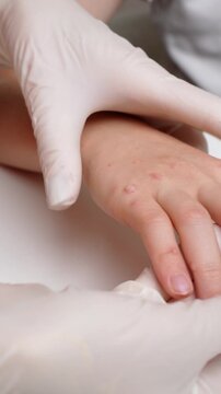 Doctor examines child's hand affected by multiple viral warts (Verruca vulgaris). Human papillomavirus (HPV). Concept of skin diseases, wart removal