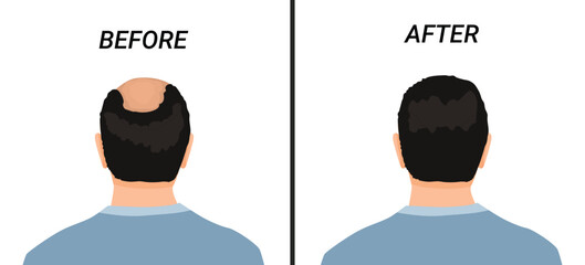 Back view male head before and after hair transplant or hair loss treatment