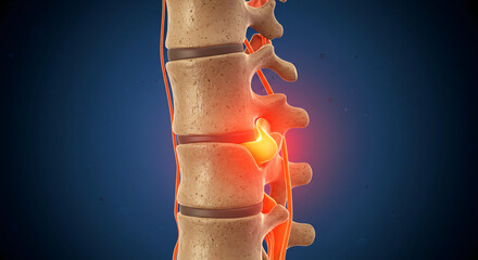 3D Cross-Section of Herniated Disc Pressing Spinal Nerve