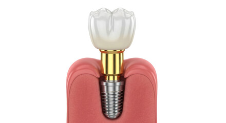 Isolated Dental Implant with Crown, demonstrating structure and gum anatomy for medical education