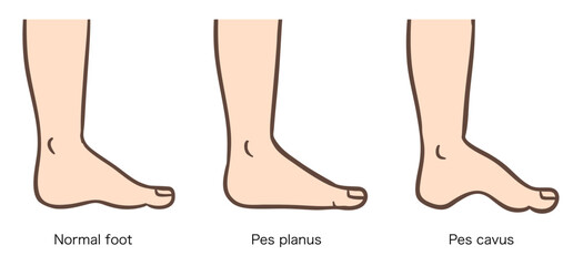 足の変形、正常な足、扁平足、凹足のイラストセット02