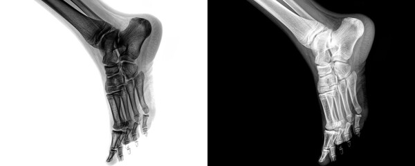 Diagnostic X-Ray of Human Ankle Joint in Lateral View Depicting Bone Structure and Joint Alignment...