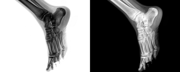 Diagnostic X-Ray of Human Ankle Joint in Lateral View Depicting Bone Structure and Joint Alignment Isolated on Transparent