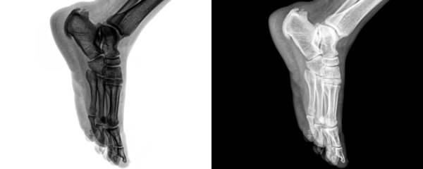 Medical Radiograph of Ankle Joint Lateral View Demonstrating Skeletal Framework and Bone Anatomy for Fracture Detection Isolated on Transparent 