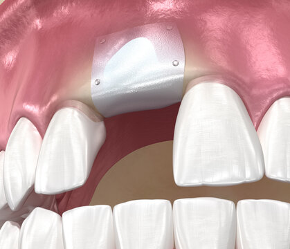 Bone grafting augmentation, socket preservation, tooth implantation. Medically accurate 3D illustration.