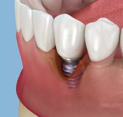 Peri-implantitis with visible gingiva recession. Medically accurate 3D illustration.