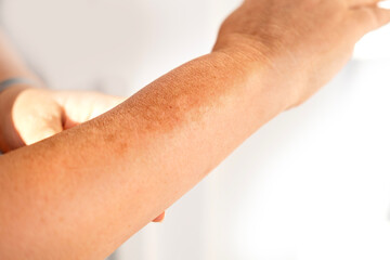 Fototapeta premium Close-up mature woman’s hand with age spots and pigmentation, showing signs of melanin overproduction, aging skin, and natural changes, skincare and health concept, hyperpigmentation