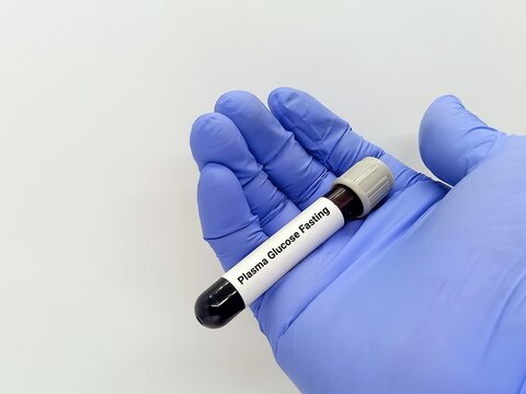 Doctor hold Blood samples for Plasma glucose Fasting (FGP) test. Fasting blood sugar(FBS) for diagnosis hyperglycemia or hypoglycemia in Diabetes Mellitus (DM). 
