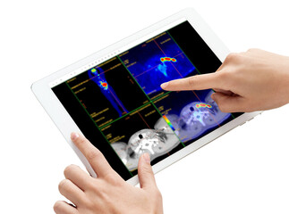 Hand interacting with tablet displaying PET/CT scans. Multiview diagnostic imaging highlights abnormal metabolic activity. Ideal for medical, oncology, and tech-related visuals.