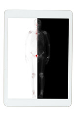 Whole body bone scan on the tablet was performed following intravenous injection of Tc-99m MDP showing  No definite evidence of bone metastasis .