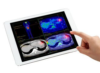 Hand interacting with tablet displaying PET/CT scans. Multiview diagnostic imaging highlights abnormal metabolic activity. Ideal for medical, oncology, and tech-related visuals.