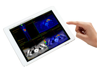 Hand interacting with tablet displaying PET/CT scans. Multiview diagnostic imaging highlights abnormal metabolic activity. Ideal for medical, oncology, and tech-related visuals.