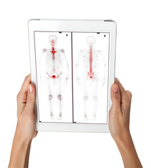 Hand interacting with tablet displaying PET/CT scans. Multiview diagnostic imaging highlights abnormal metabolic activity. Ideal for medical, oncology, and tech-related visuals.