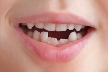 A close-up of a child's smiling mouth showing a missing front tooth and another new tooth emerging.
Concept of: Childhood dental development.