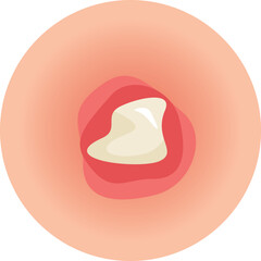 Acne and Pimple Vector Illustration