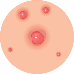 Acne and Pimple Vector Illustration