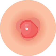 Acne and Pimple Vector Illustration