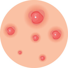 Acne and Pimple Vector Illustration