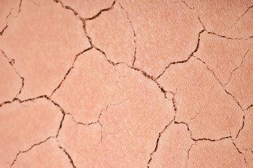 Dry skin presented as double exposure with cracked soil