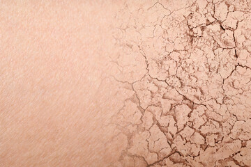 Dry skin presented as double exposure with cracked soil