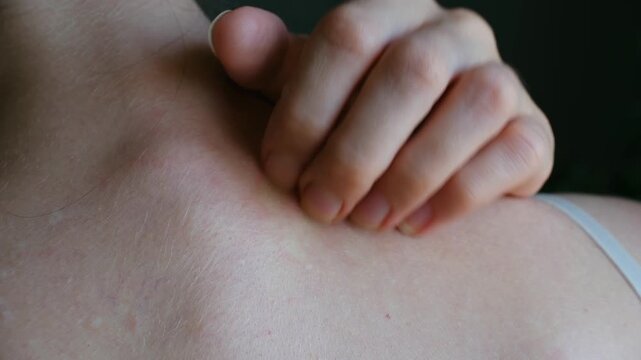 Young woman scratching her shoulder and neck, suffering from an allergic reaction or insect bite, showing red irritated skin. Close up view of dermatology problems and skin health care