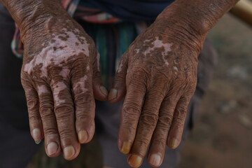 Close-up of Elderly Hands with Skin Conditions Showcasing Unique Textures and Patterns Representing...