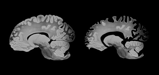 Alzheimer brain comparison in sagittal view showing differences between a healthy and affected brain, highlighting cortical atrophy and neurodegeneration, displayed on a black background.