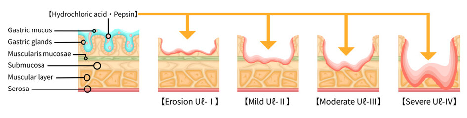胃潰瘍　重症度　イラスト　英語