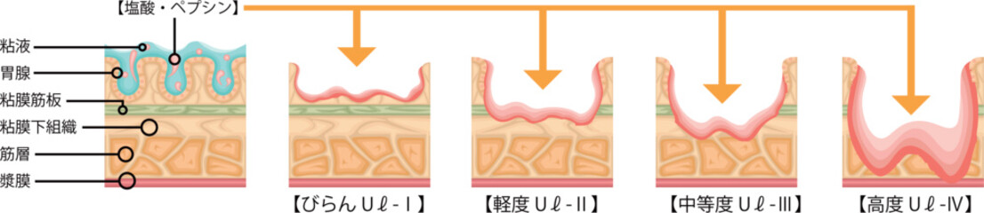 胃潰瘍　重症度　イラスト　日本語