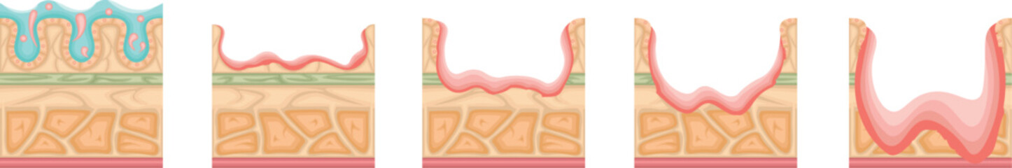 胃潰瘍　重症度　イラスト