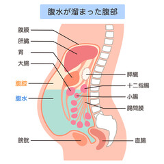 腹水が溜まった腹部