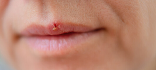 Fototapeta premium Close up of woman lips showing herpes blister caused by cold or stress. Banner concept of illness, health awareness, and personal hygiene.
