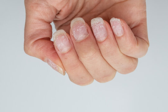 Damaged fingernails after gel polish removal. A natural hand with problematic cuticles and broken nails. Emotional stress. Age-related skin changes. Concept of nail care Hand care.