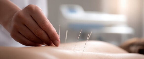 The Acupuncture Needles on a Patient's Relaxed Back During a Treatment Session