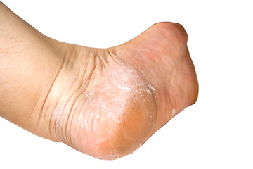 Close-Up of Dry Cracked Heel Skin with Visible Calluses on Foot