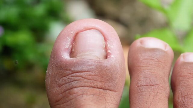 Close up of a bad smelling big toe surrounded by small Drosofila flies (Drosophilidae)