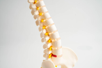 Naklejka premium Spinal nerve and bone, Lumbar spine displaced herniated disc fragment, Model for treatment medical in the orthopedic department.