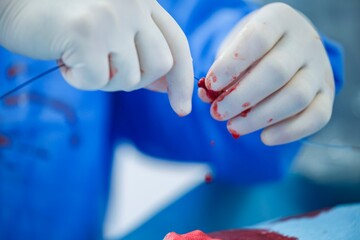 Medical professionals skillfully manipulate biocompatible microspheres during a therapeutic procedure aimed at treating hypervascular liver tumors, enhancing future treatment possibilities