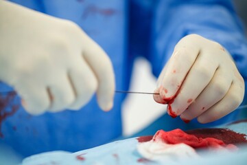 Careful hands prepare drug-eluting microspheres during a crucial surgical procedure to enhance tumor targeting and treatment efficacy in a clinical setting