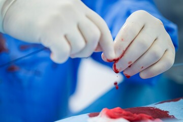 Surgeon delicately handles resorbable microspheres during a procedure aimed at enhancing treatment for liver tumors, focusing on precision and safety