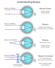 Medical infographic explaining myopia, normal vision, and corrective measures with concave lenses. Ideal for eye health education and visual clarity topics. Ophthalmology content nearsightedness.