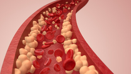 Fat embolism syndrome, Blood cell and Blood vessels with Cholesterol, 3D rendering