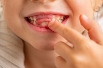 funny toothless 6-year-old girl, touching wobbly tooth, child baby tooth fell out, childhood moment...