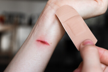 A person applies a medical plaster to a burn on their forearm. The skin is light with a visible red mark from the burn. The plaster is beige and held in one hand.