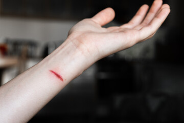 A close-up of a pale arm with a fresh burn mark. The skin shows a red line indicating injury. The...