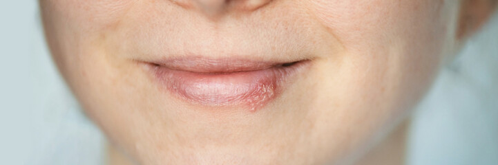 Close-up of female lips with cold sore on lower lip.