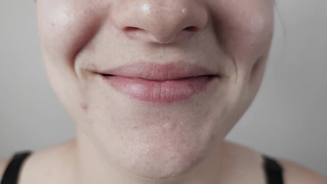 Close-up macro shot of a young woman's lower face smiling with closed mouth. Shows natural problem skin with acne, visible pores and dimples on her cheeks against a plain white background.