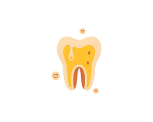 Vector illustration of a tooth cross-section showing advanced decay and cavities