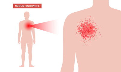 Dermatitis skin disease