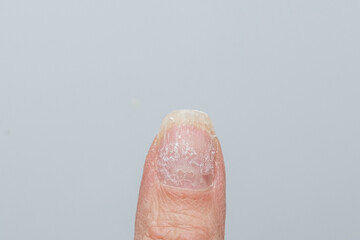 Damaged fingernail with peeling layers and dry cuticle. A finger with problematic cuticles and broken nails. Emotional stress. Age-related skin changes. Concept of nail care